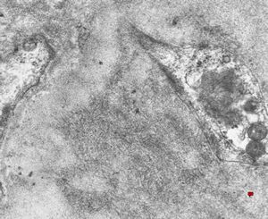 F,40y. | fibrillary glomerulopathy (amyloid negative)